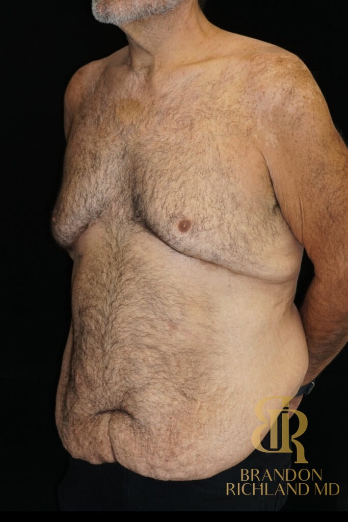 Gynecomastia Surgery Before photo, Patient 07