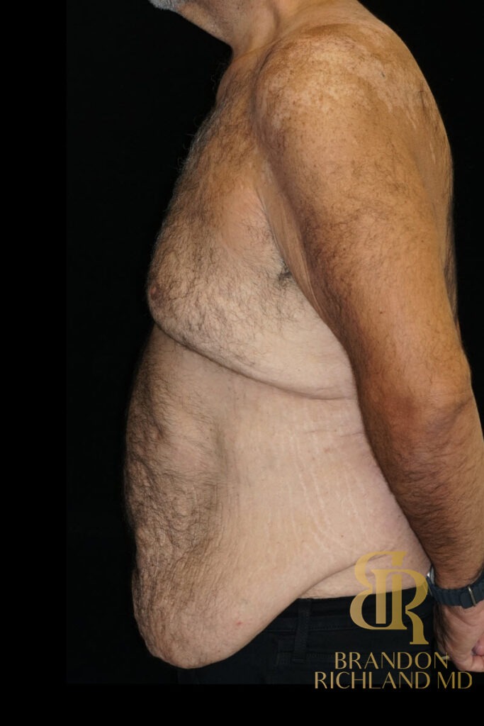 Gynecomastia Surgery Before photo, Patient 07