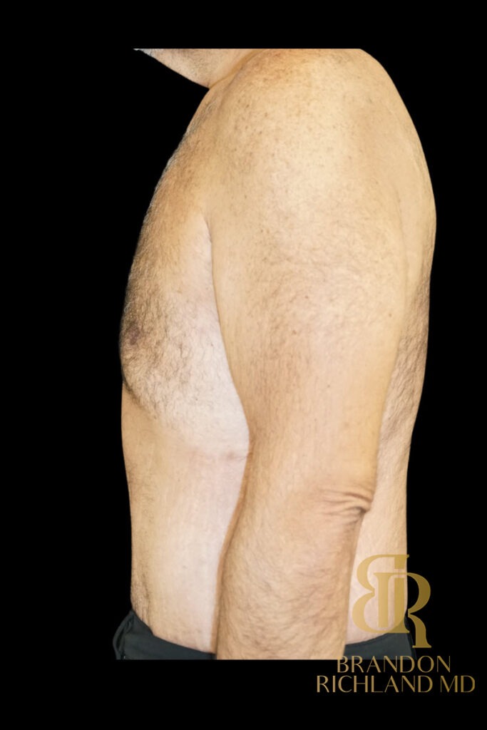 Gynecomastia Surgery After photo, Patient 07