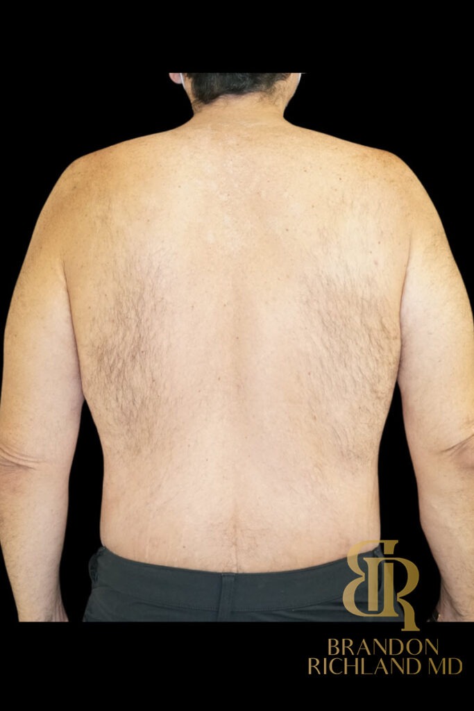 Gynecomastia Surgery After photo, Patient 07