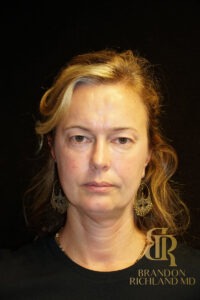 Brow Lift before and after, Patient 01 — Dr. Brandon Richland, Newport Beach