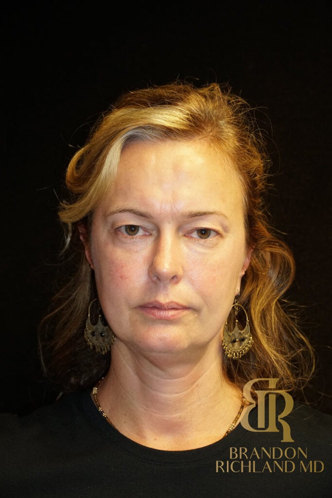 Brow Lift Before, Patient 01, view 2 — Dr. Brandon Richland, Newport Beach