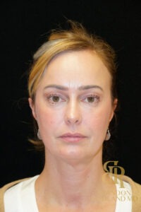 Brow Lift before and after, Patient 01 — Dr. Brandon Richland, Newport Beach