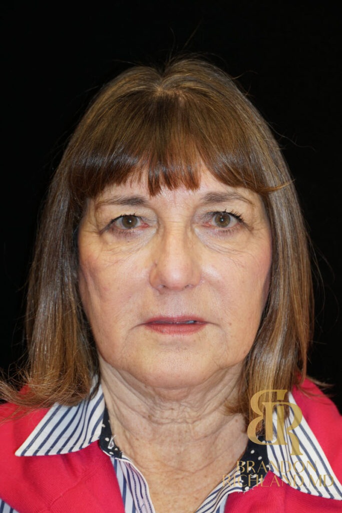Brow Lift Before photo, Patient 02