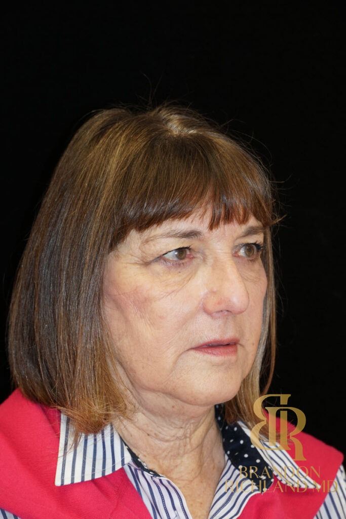 Brow Lift Before photo, Patient 02