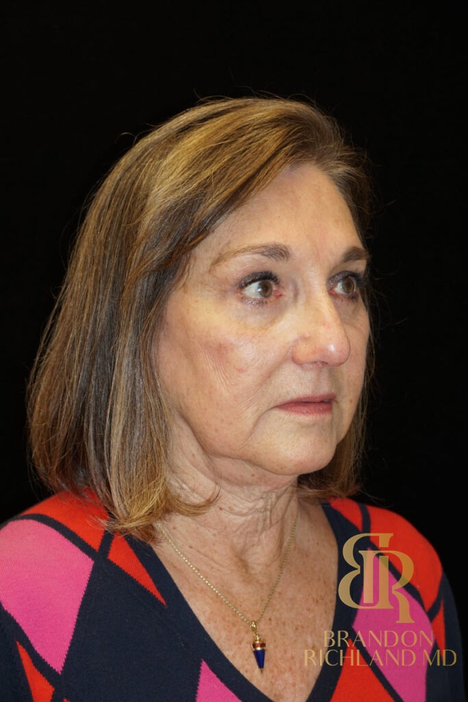 Brow Lift After photo, Patient 02