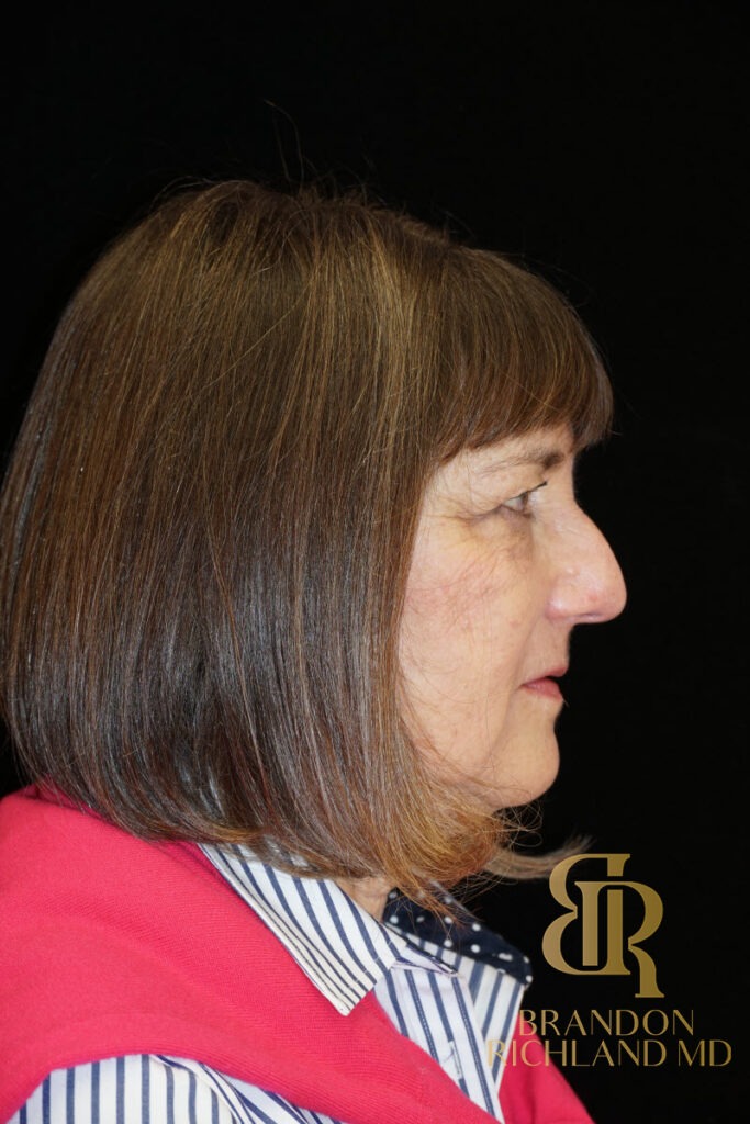 Brow Lift Before photo, Patient 02