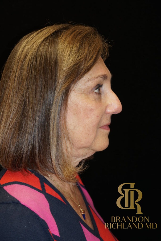 Brow Lift After photo, Patient 02
