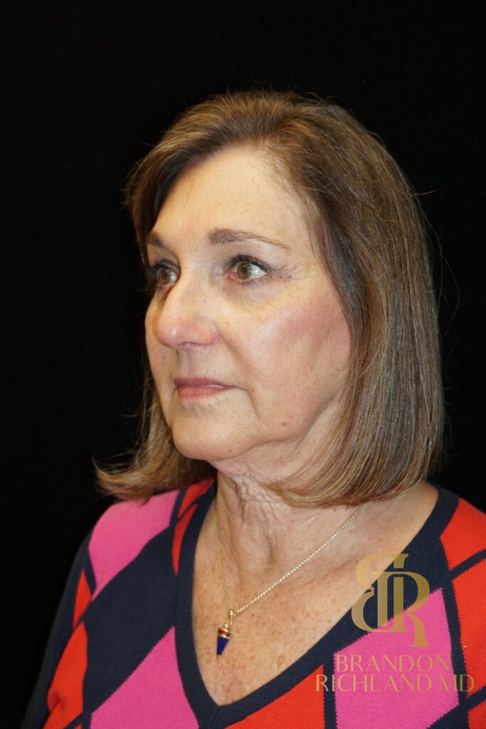 Brow Lift After photo, Patient 02