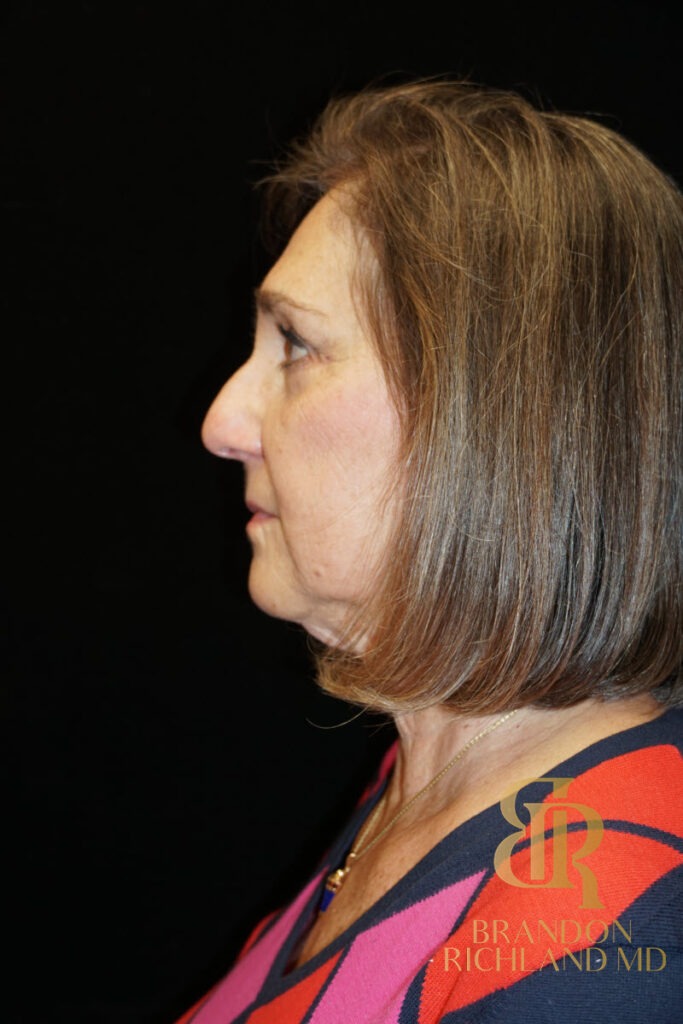 Brow Lift After photo, Patient 02