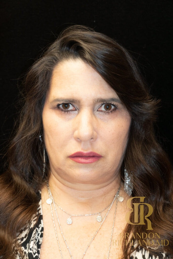 Brow Lift Before photo, Patient 03