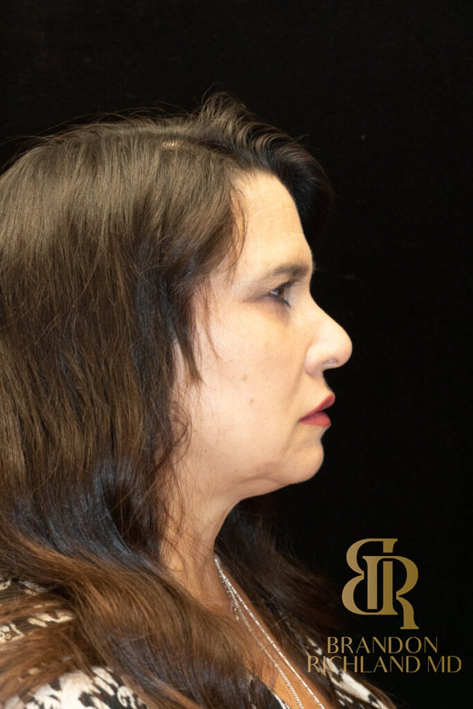 Brow Lift Before photo, Patient 03