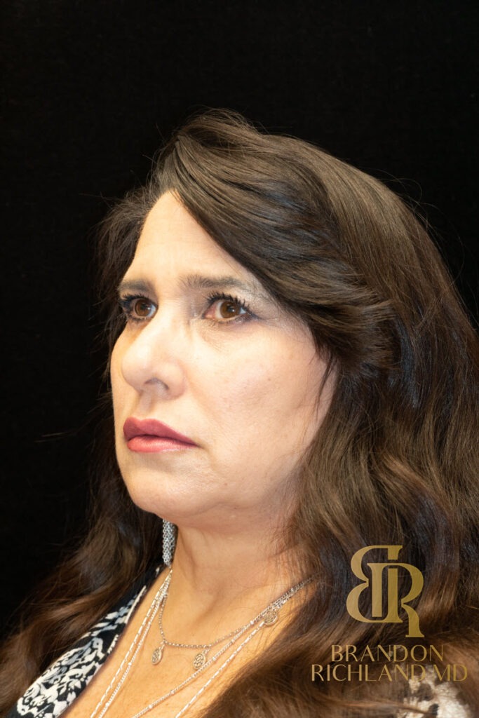 Brow Lift Before photo, Patient 03