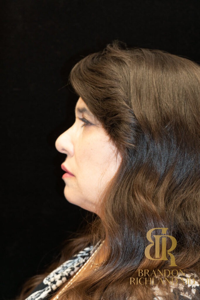 Brow Lift Before photo, Patient 03