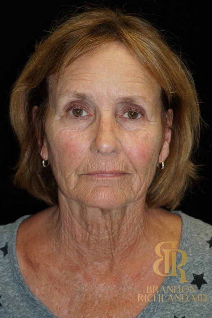 Brow Lift Before, Patient 04, view 1 — Dr. Brandon Richland, Newport Beach