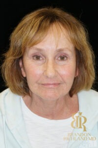Brow Lift before and after, Patient 04 — Dr. Brandon Richland, Newport Beach