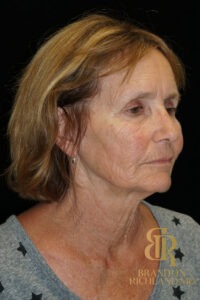 Brow Lift before and after, Patient 04 — Dr. Brandon Richland, Newport Beach