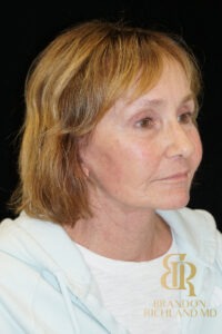 Brow Lift before and after, Patient 04 — Dr. Brandon Richland, Newport Beach