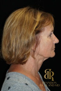 Brow Lift before and after, Patient 04 — Dr. Brandon Richland, Newport Beach
