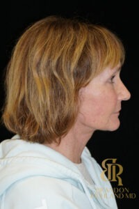 Brow Lift before and after, Patient 04 — Dr. Brandon Richland, Newport Beach