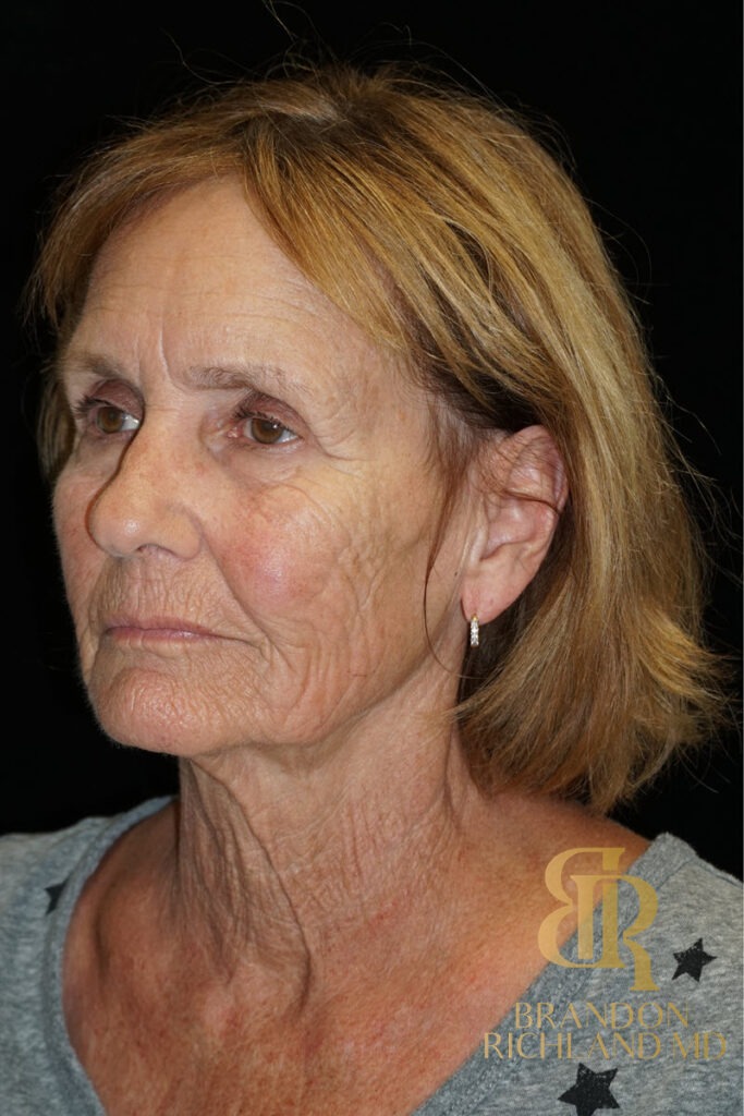 Brow Lift Before, Patient 04, view 4 — Dr. Brandon Richland, Newport Beach