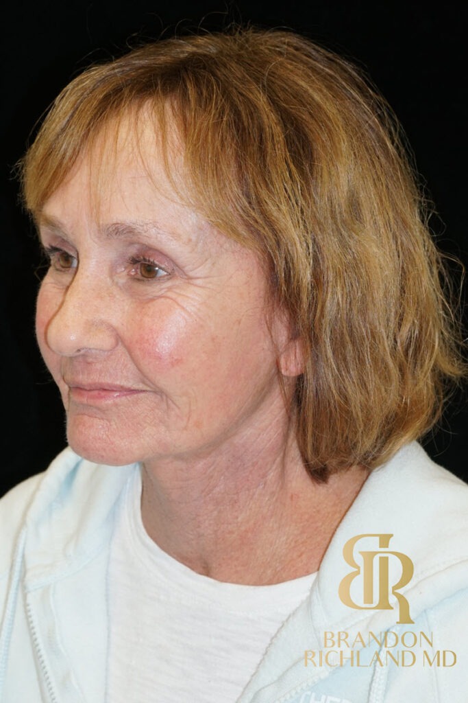 Brow Lift After, Patient 04, view 4 — Dr. Brandon Richland, Newport Beach