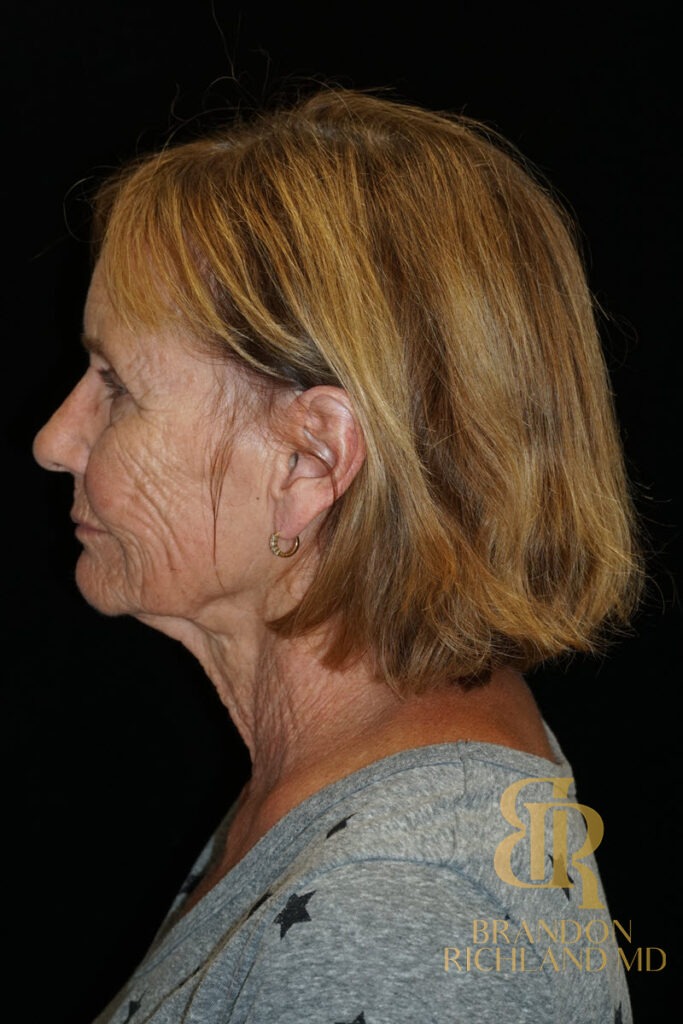 Brow Lift Before, Patient 04, view 5 — Dr. Brandon Richland, Newport Beach