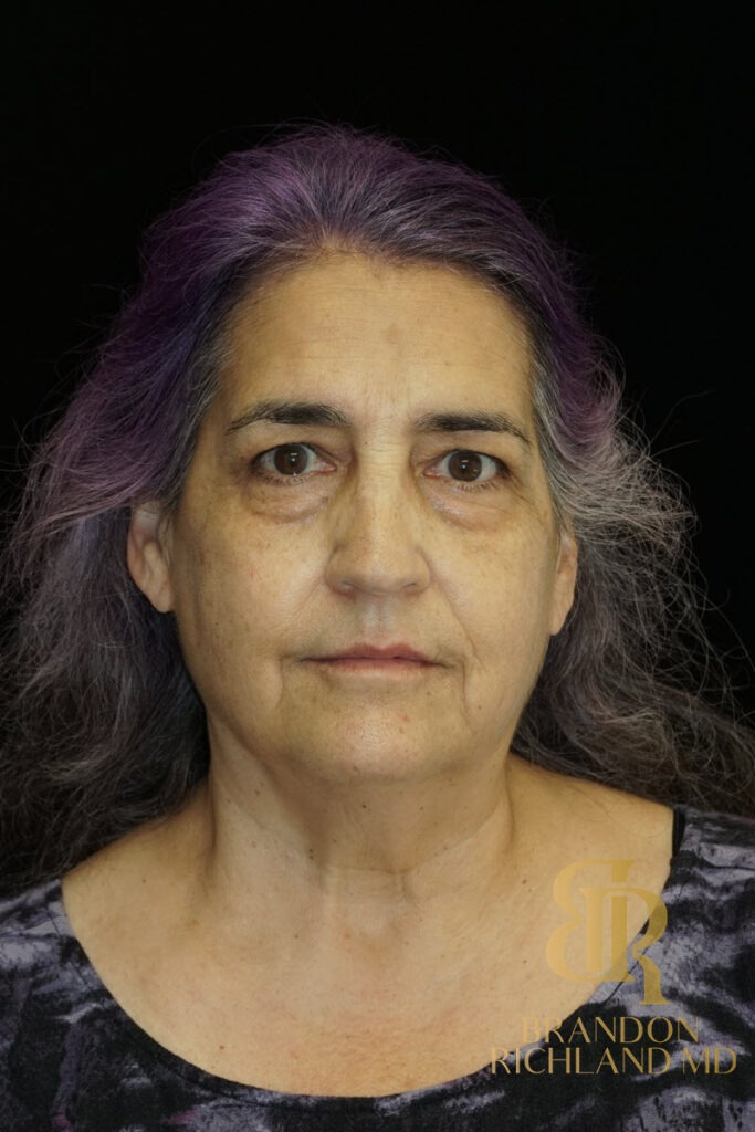 Brow Lift Before photo, Patient 05