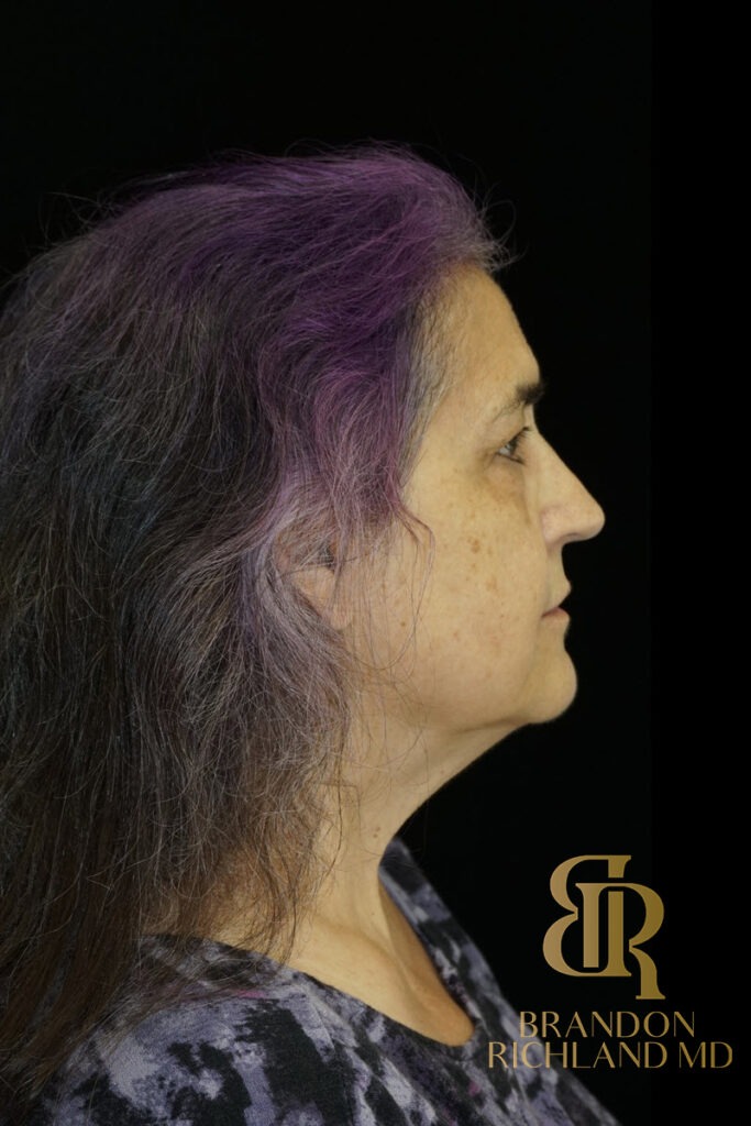 Brow Lift Before photo, Patient 05