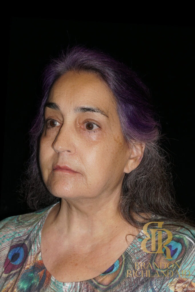 Brow Lift After photo, Patient 05