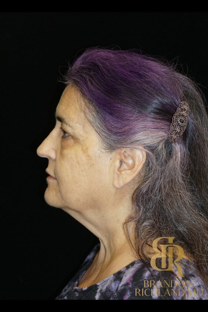 Brow Lift Before photo, Patient 05