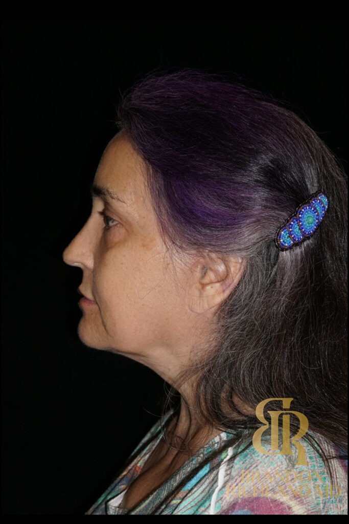 Brow Lift After photo, Patient 05