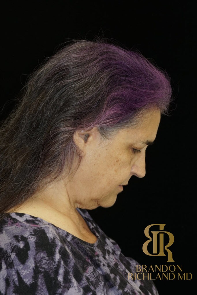 Brow Lift Before photo, Patient 05