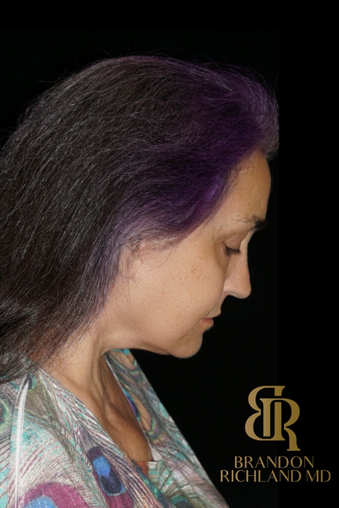 Brow Lift After photo, Patient 05