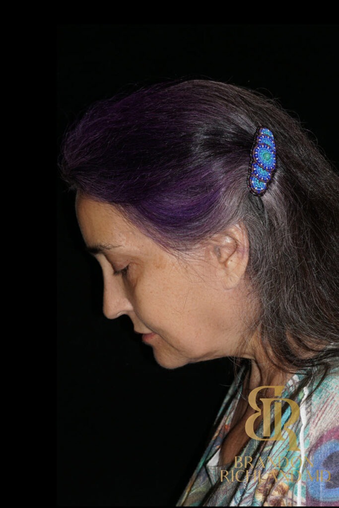 Brow Lift After photo, Patient 05