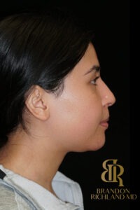Chin Augmentation before and after, Patient 02 — Dr. Brandon Richland, Newport Beach