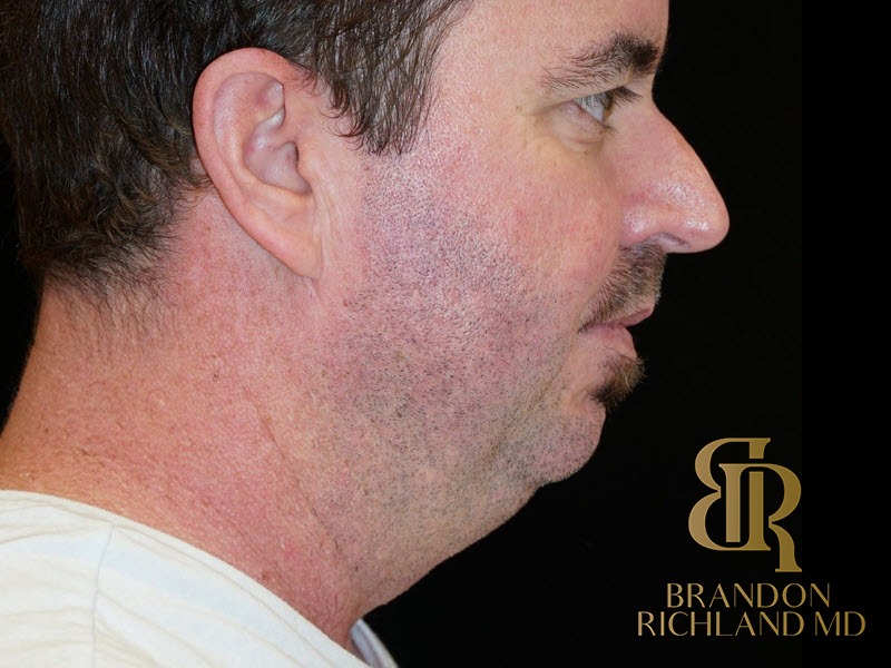 Chin Liposuction Before, Patient 01, view 1 — Dr. Brandon Richland, Newport Beach
