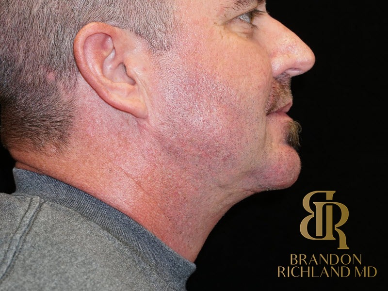Chin Liposuction After, Patient 01, view 3 — Dr. Brandon Richland, Newport Beach
