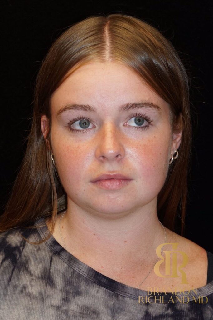 Chin Liposuction Before, Patient 02, view 1 — Dr. Brandon Richland, Newport Beach