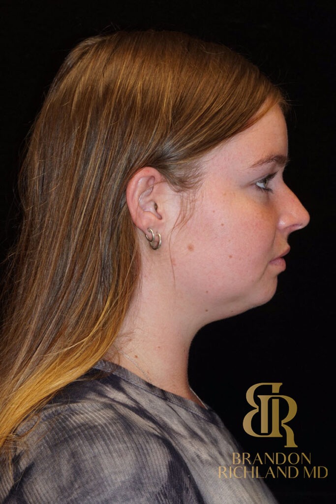 Chin Liposuction Before, Patient 02, view 3 — Dr. Brandon Richland, Newport Beach