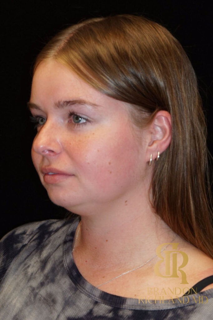 Chin Liposuction Before, Patient 02, view 4 — Dr. Brandon Richland, Newport Beach