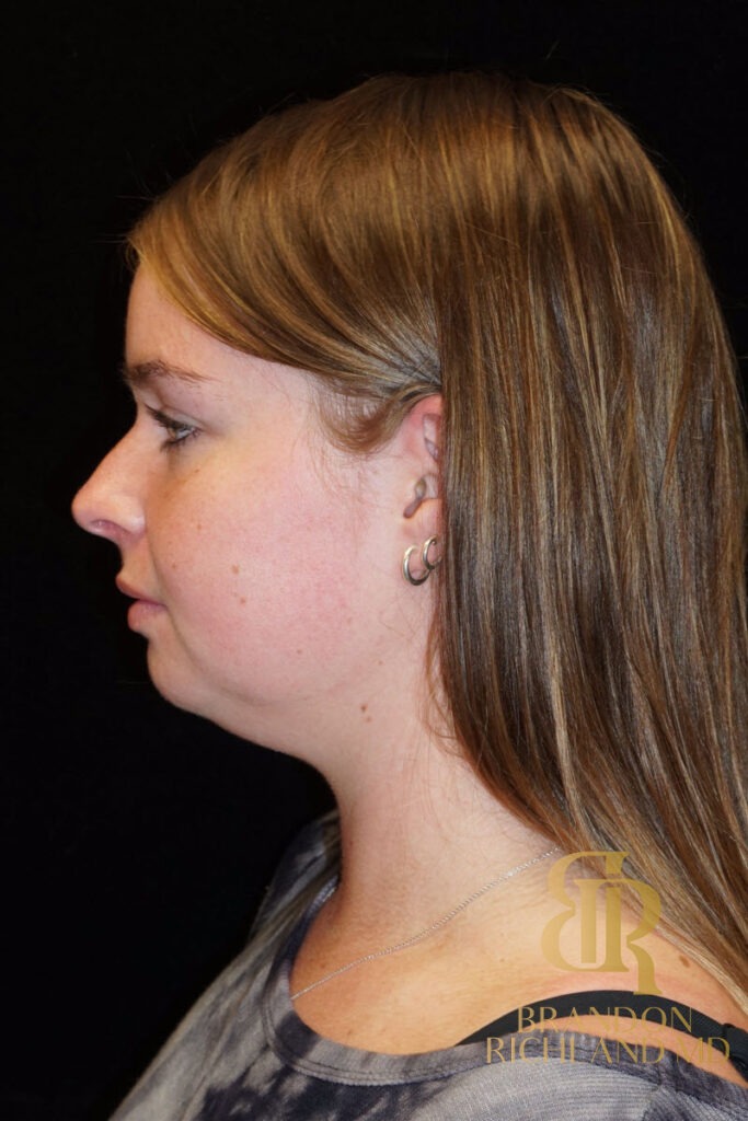 Chin Liposuction Before, Patient 02, view 5 — Dr. Brandon Richland, Newport Beach