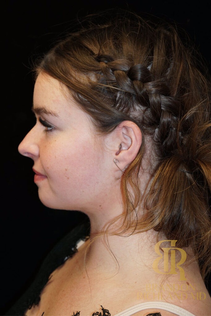 Chin Liposuction After, Patient 02, view 5 — Dr. Brandon Richland, Newport Beach