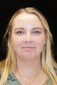 Chin Liposuction before and after, Patient 03 — Dr. Brandon Richland, Newport Beach