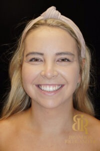 Chin Liposuction before and after, Patient 03 — Dr. Brandon Richland, Newport Beach