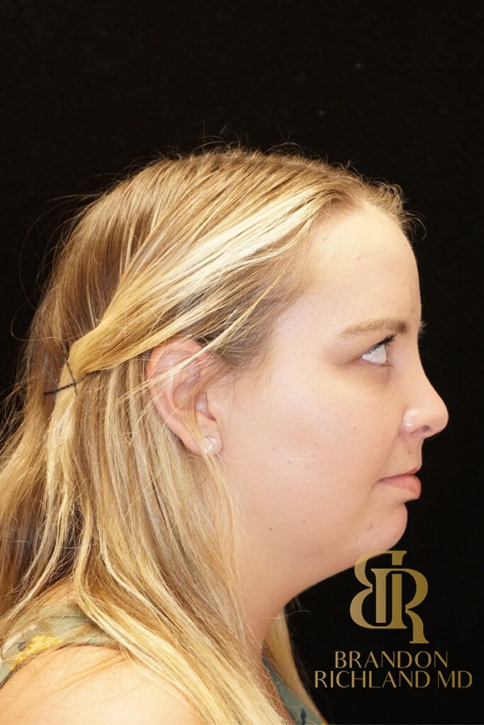 Chin Liposuction Before, Patient 03, view 3 — Dr. Brandon Richland, Newport Beach