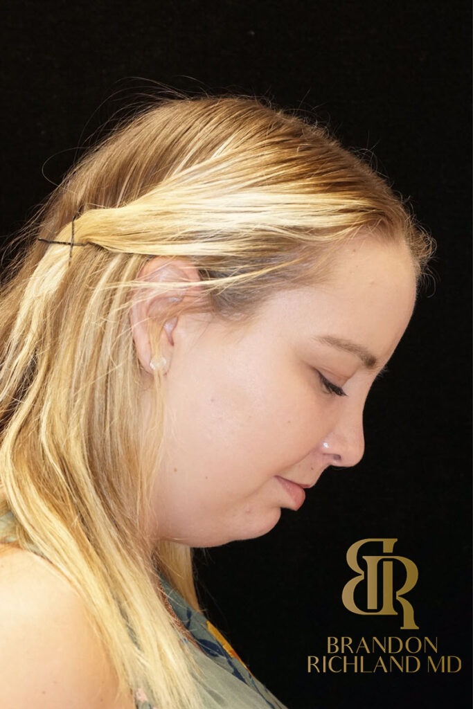 Chin Liposuction Before, Patient 03, view 4 — Dr. Brandon Richland, Newport Beach