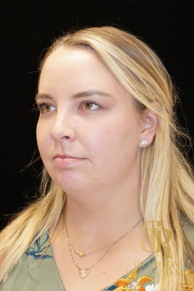 Chin Liposuction Before, Patient 03, view 5 — Dr. Brandon Richland, Newport Beach