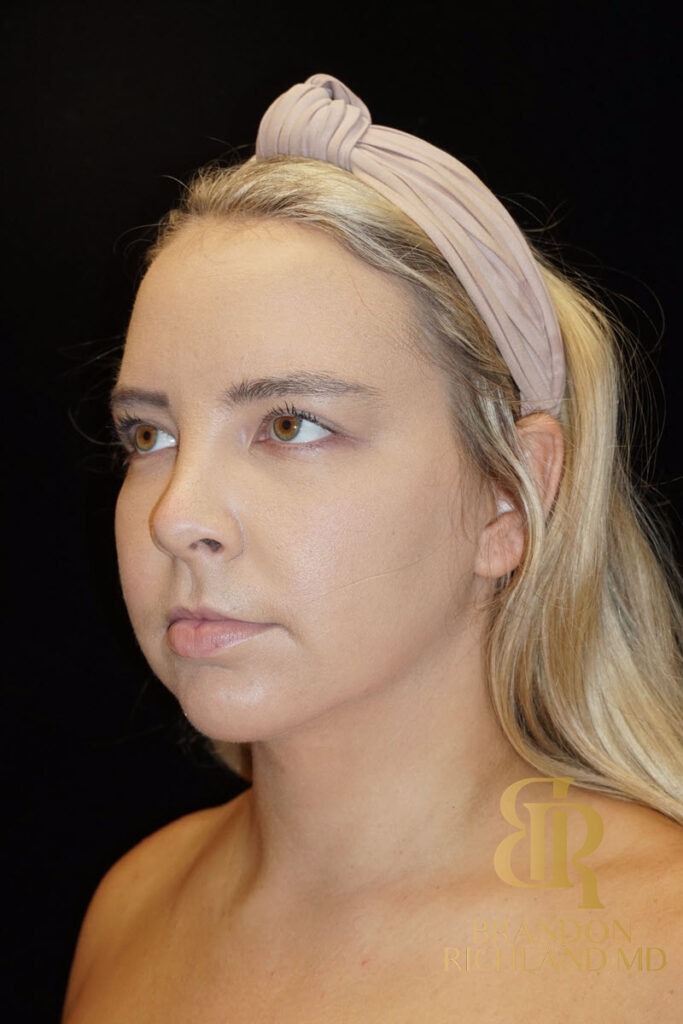 Chin Liposuction After, Patient 03, view 5 — Dr. Brandon Richland, Newport Beach