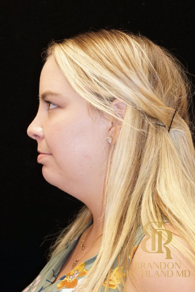 Chin Liposuction Before, Patient 03, view 6 — Dr. Brandon Richland, Newport Beach